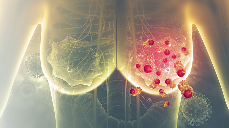 Câncer de Mama: Guia completo de Direitos (2026)