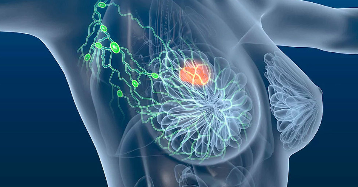 Liminar para Câncer de Mama 2026: Como conseguir cirurgia e remédios