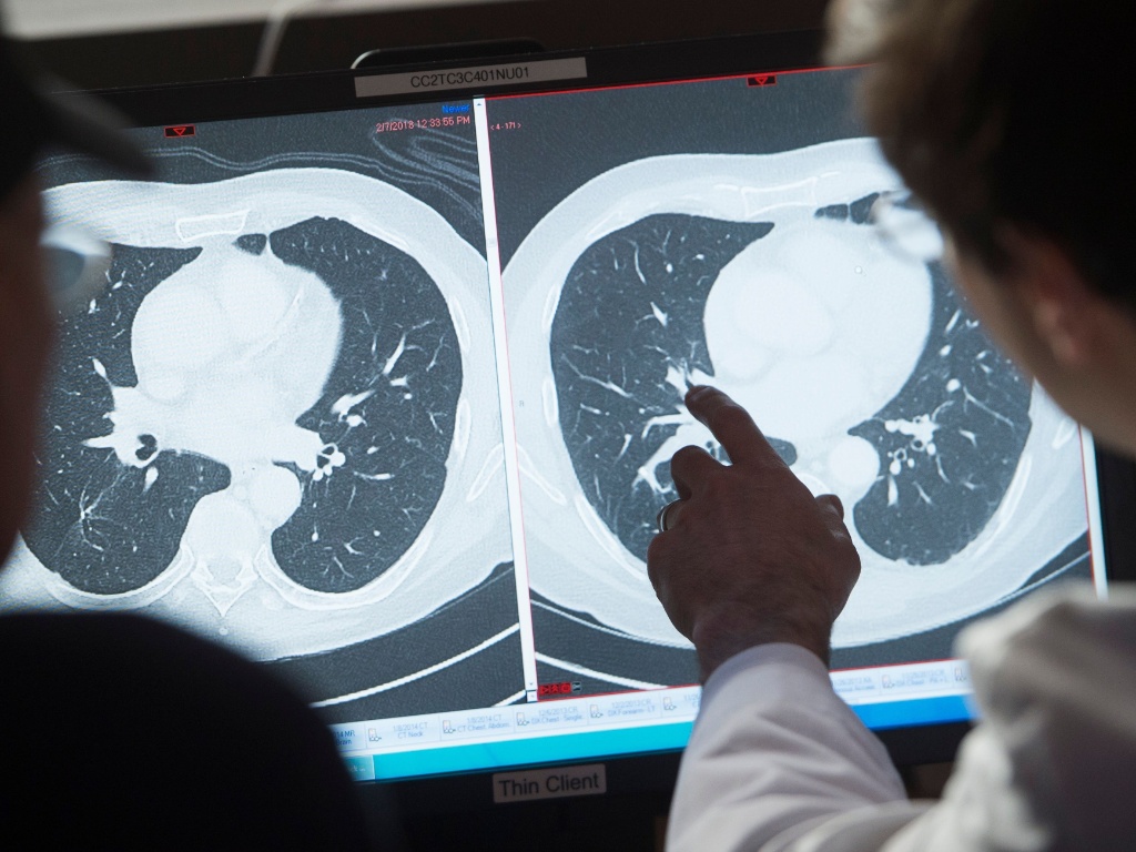 Negativa de Ipilimumabe (Yervoy®)